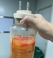 巨野水动力吸脂手术要做多久？